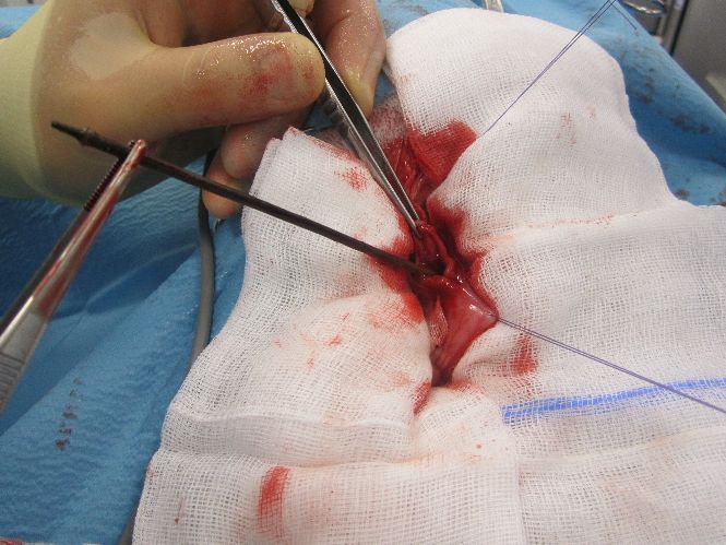 Migrated foreign body removal